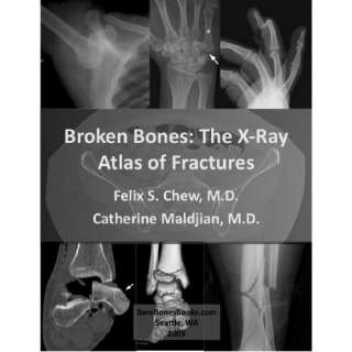 Image Broken Bones The X Ray Atlas of Fractures Felix S. Chew 