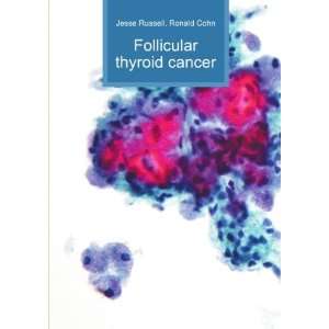  Follicular thyroid cancer Ronald Cohn Jesse Russell 
