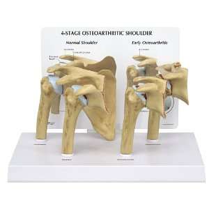   Osteoarthritic (OA) 4 Stage Anatomical Model